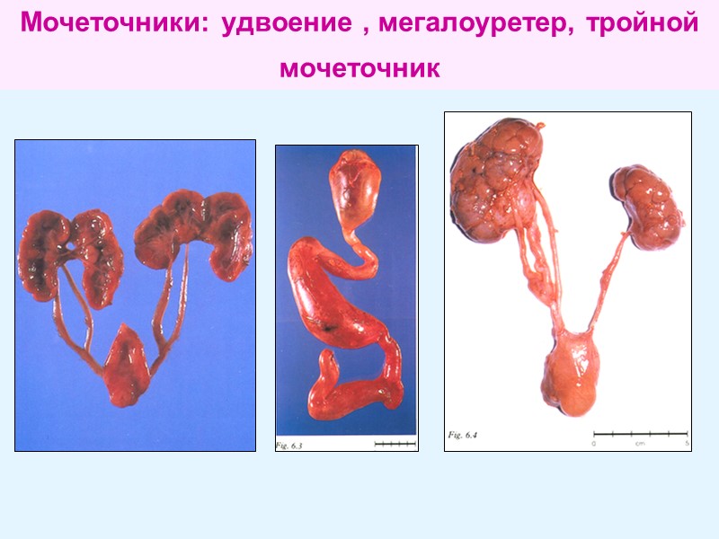 Мочеточники: удвоение , мегалоуретер, тройной мочеточник